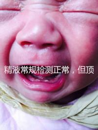 精液常規檢測正常，但頂體酶低，是否影響試管嬰兒成功率？