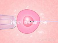 時(shí)間短、操作簡單，分步驟解讀宮頸擴(kuò)張術(shù)全過程