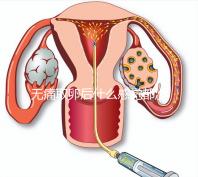 無痛取卵后什么感覺都沒有異常是謠言！只會出現(xiàn)一部分...