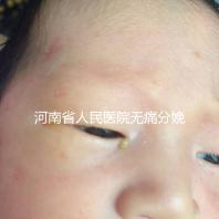 河南省人民醫院無痛分娩多少錢戳，收費標準60s看懂不踩坑