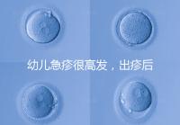 幼兒急疹很高發，出疹后的護理方法及注意事項提前知曉！