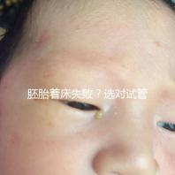 胚胎著床失?。窟x對試管嬰兒醫生很重要