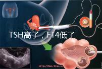 TSH高了，F(xiàn)T4低了，需要補碘嗎？